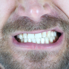 Tandenknarsen (3)